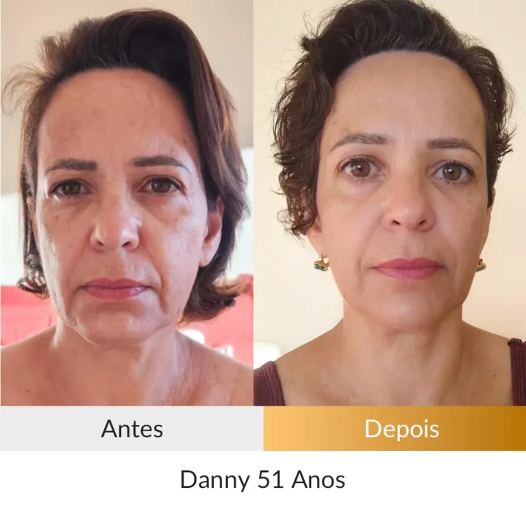 Depoimento-Metodo-Rosto-Firme-Foto-Danny-51-anos.webp