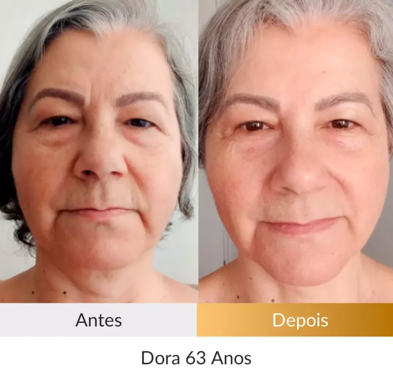 Depoimento-Metodo-Rosto-Firme-Foto-Dora-63-anos.webp