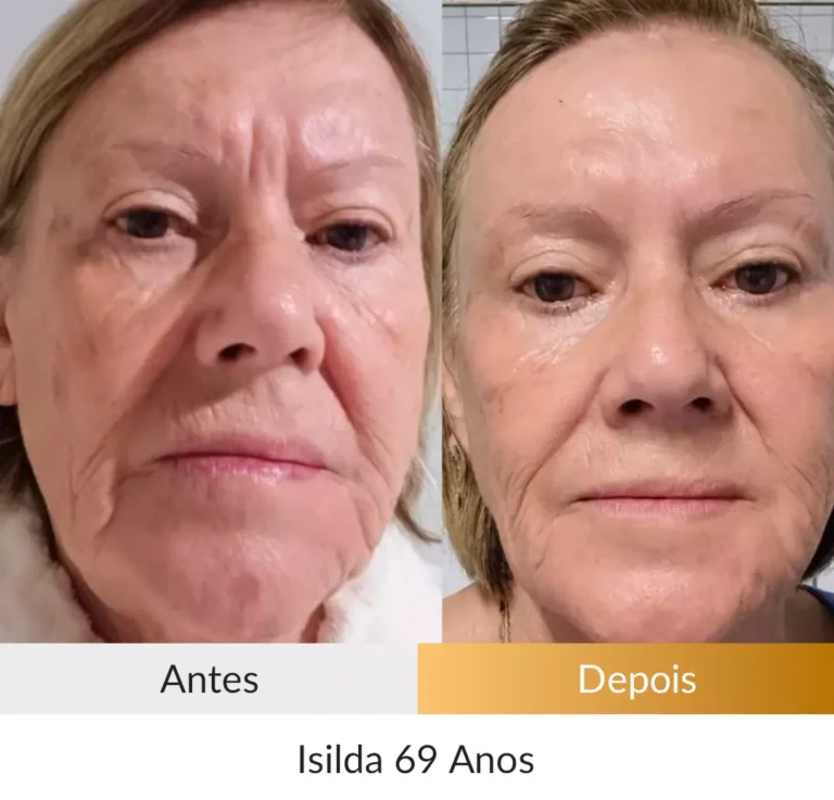 Depoimento-Metodo-Rosto-Firme-Foto-Isilda-69-anos.webp