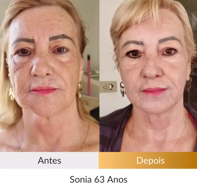 Depoimento-Metodo-Rosto-Firme-Foto-Sonia-63-anos.webp