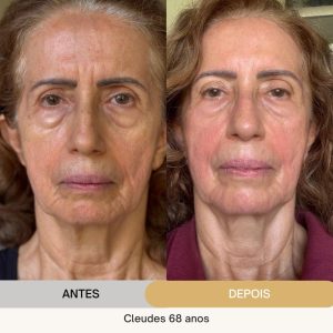 ANTES E DEPOIS (13)
