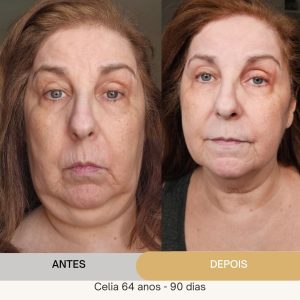 ANTES E DEPOIS (18)