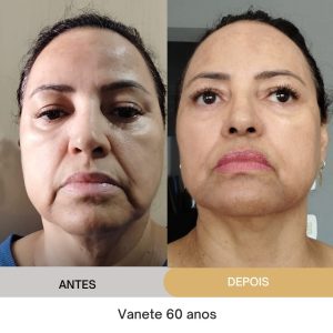 ANTES E DEPOIS (20)