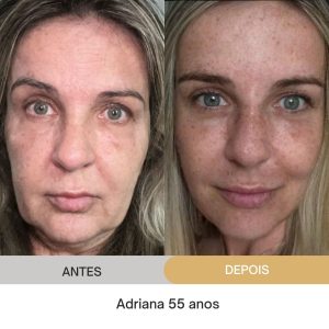 ANTES E DEPOIS (22)