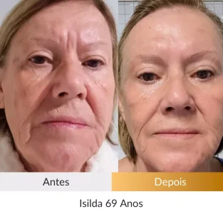 Depoimento-Metodo-Rosto-Firme-Foto-Isilda-69-anos.webp